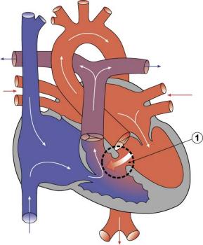 Порог сердца межжелудочковая перегородка можно ли делать прививку от ковид 19